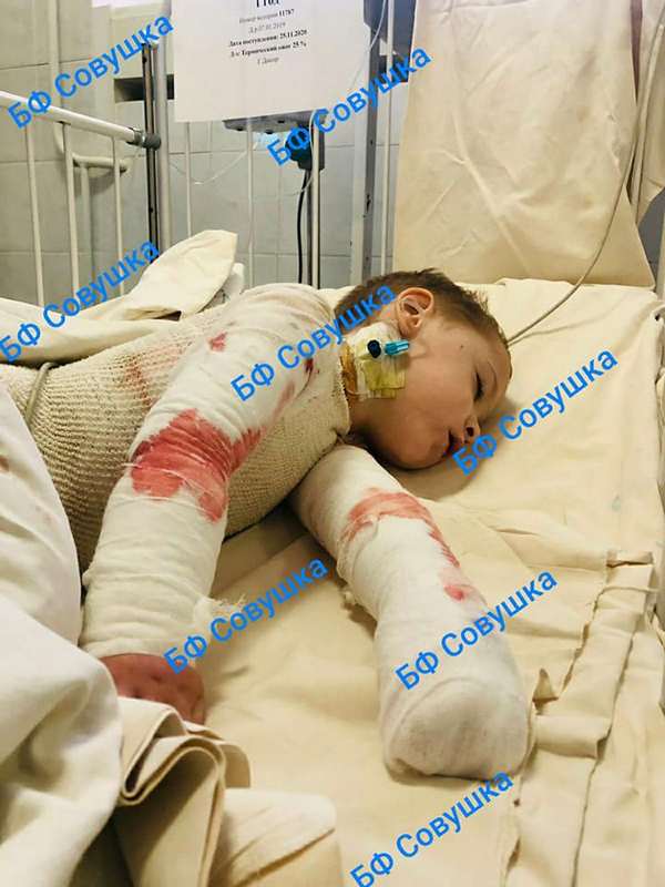В Днепре пострадал 3-летний малыш: опрокинул на себя кастрюлю с кипятком