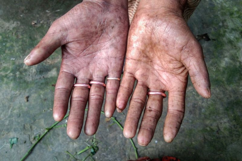В Бангладеше есть люди без отпечатков пальцев 