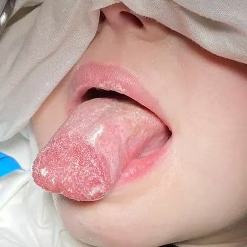 В Днепре ребенок повредил язык в бутылке с молоком