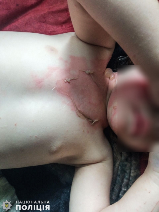 В Николаевской области 2-летняя девочка вылила на себя кипяток