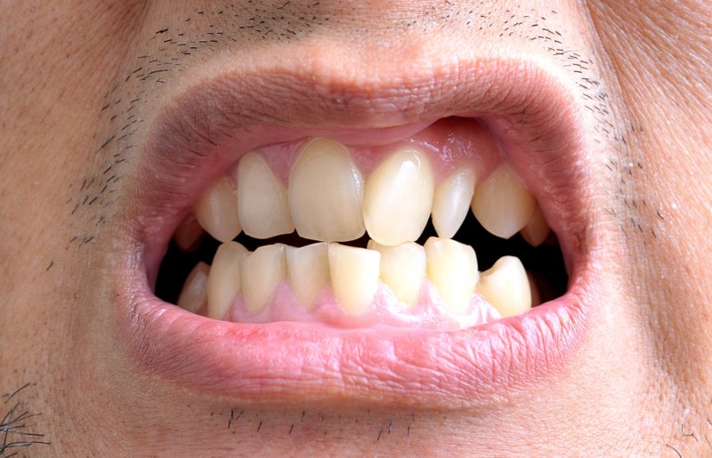 Проблемы с зубами вызывают серьезные заболевания