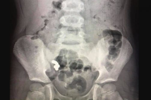 У мальчика из Прикарпатья из кишечника изъяли магнитные шарики (ФОТО)