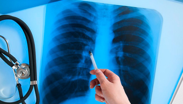Люди умирают от туберкулеза, но выявляют его только при вскрытии &#8212; эксперт