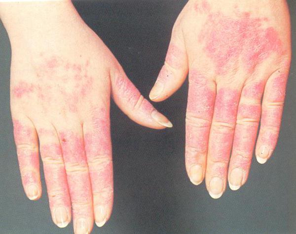 Как защититься от холодовой аллергии: советы дерматологов