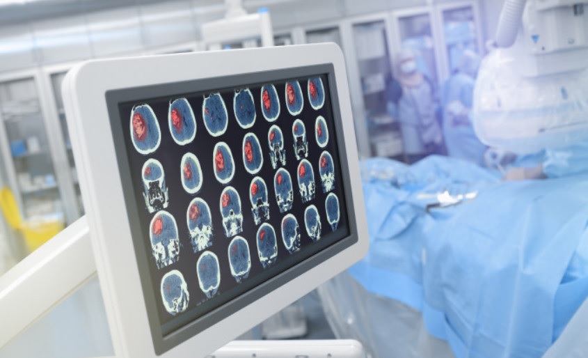 В Европе впервые в мозг человека вживили аппарат на основе ИИ