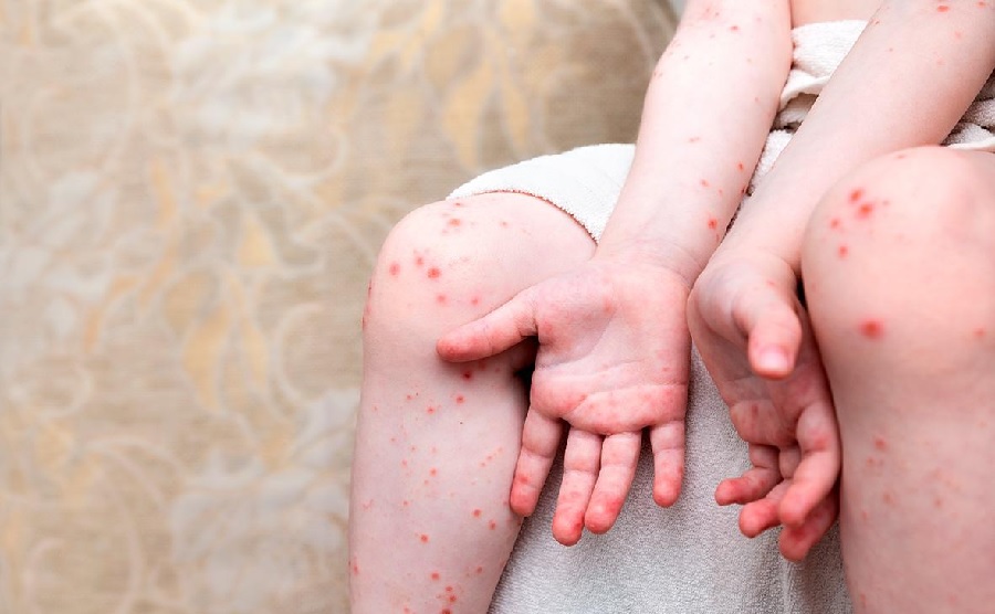 В Киевской области вирусом Коксаки заражены 13 детей