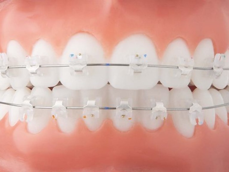 В 20% случаев брекеты в стоматологии бесполезны – медик