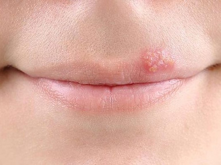 Герпес на губах повышает риск нарушений памяти &#8212; исследование