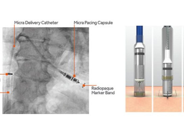 Врачи предложили имплантировать кардиостимулятор в сердце без операции (ФОТО)