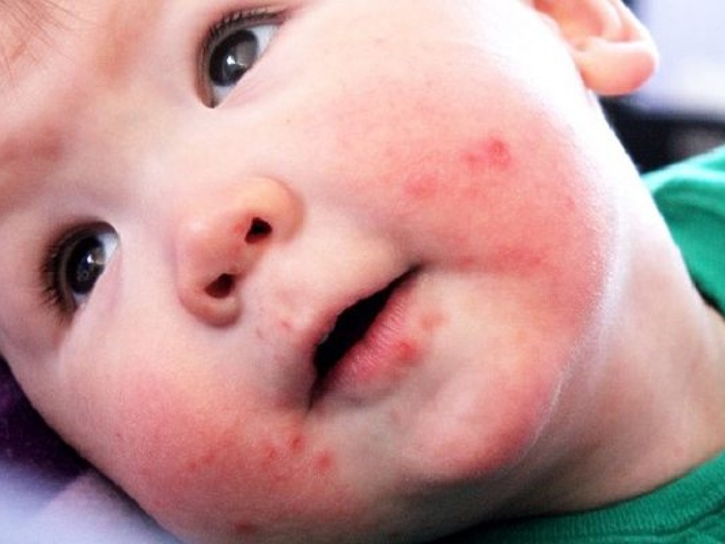 В киевском детсаду зафиксирована вспышка вируса Коксаки, заболели сразу трое малышей