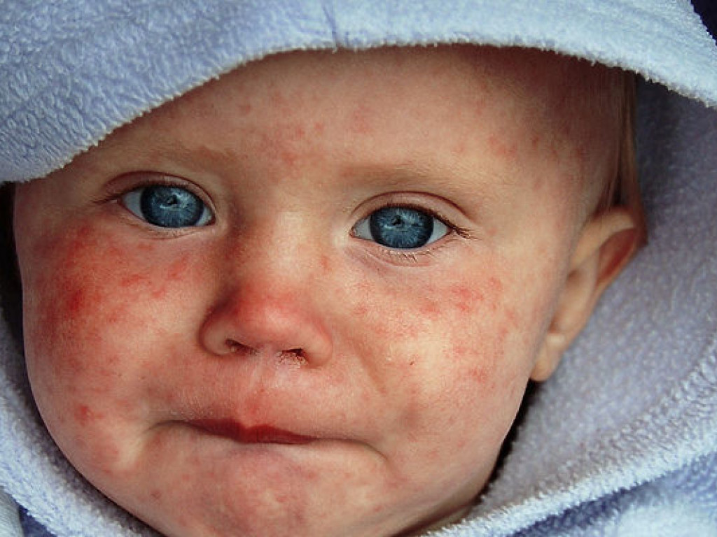 Официально: в Киеве корью заболели уже 54 человека, почти все – без прививок