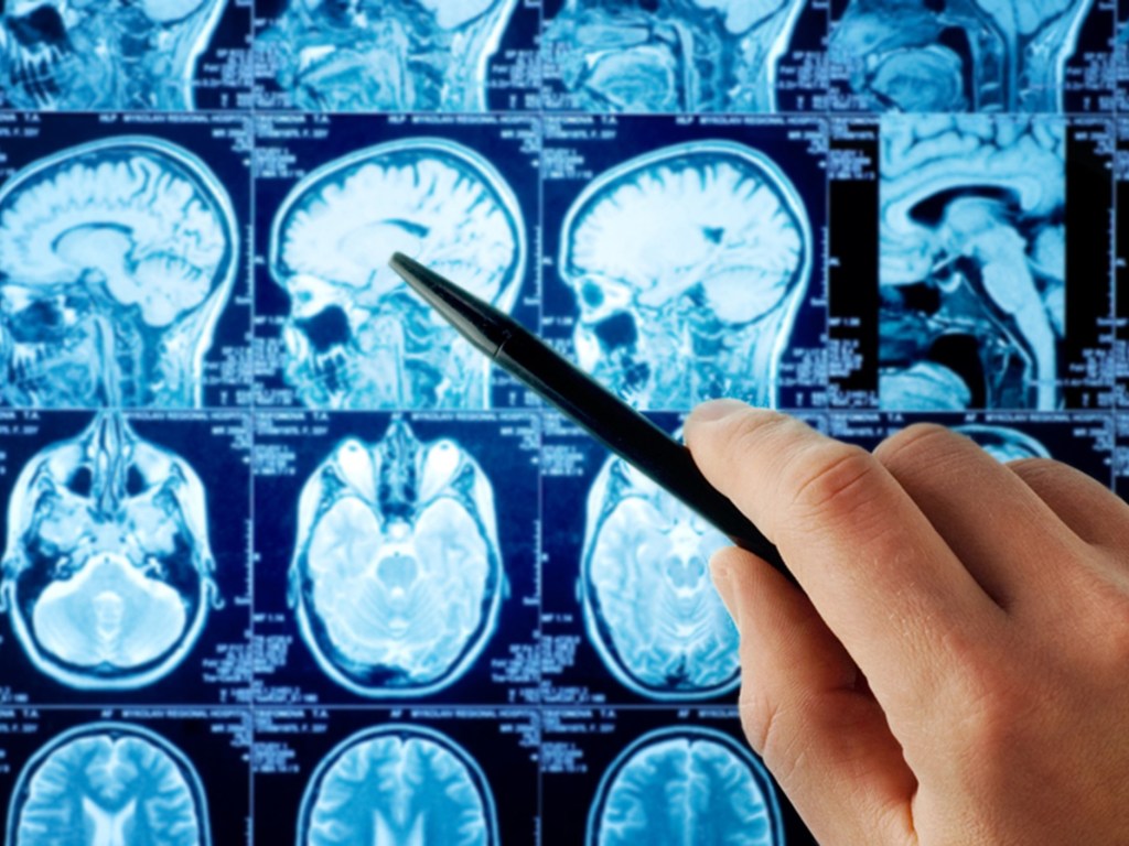 Международная группа исследователей сообщила, что они нашли способ излечить рак мозга