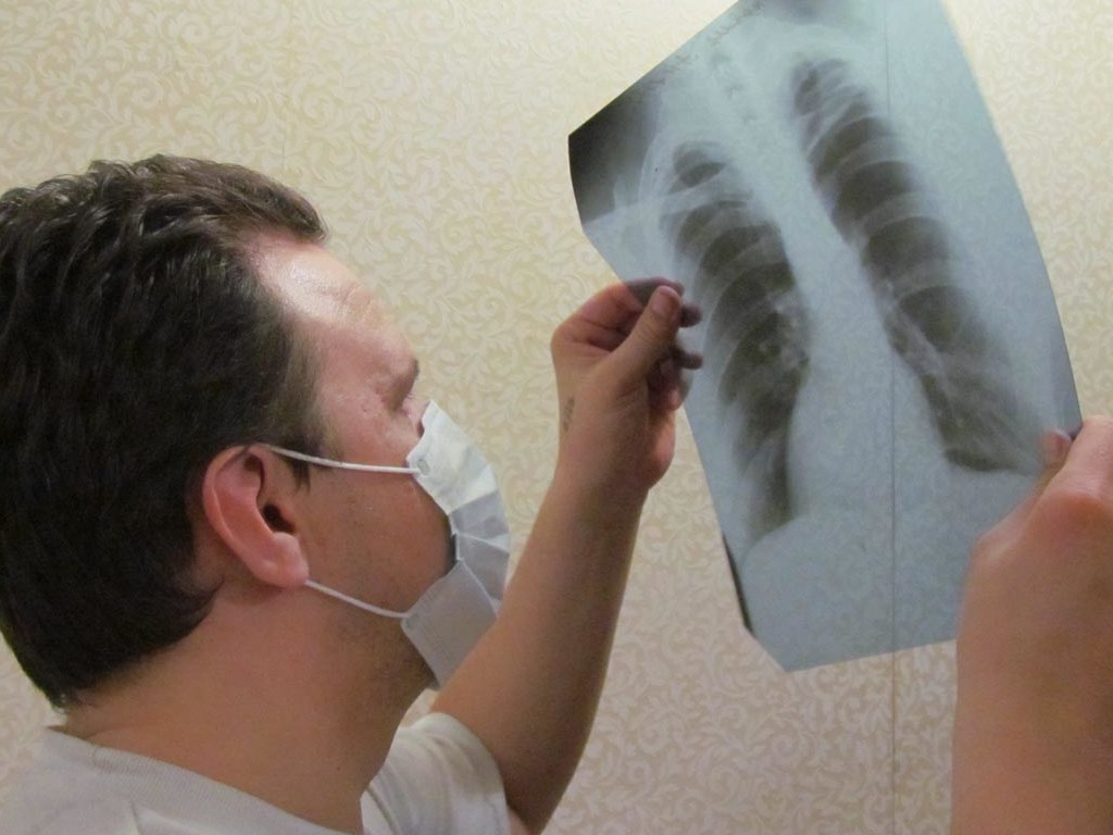 Инфекционист: Много украинцев с туберкулезом не попадают в официальную статистику