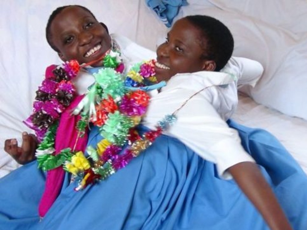 Знаменитые сиамские близнецы из Танзании умерли в возрасте 22 лет (ФОТО)