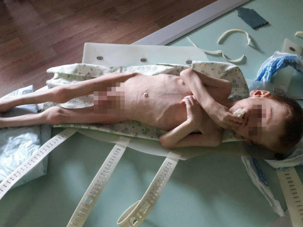 7 килограммов в 4 года: в Кировоградской области родители заморили голодом сына (ФОТО)