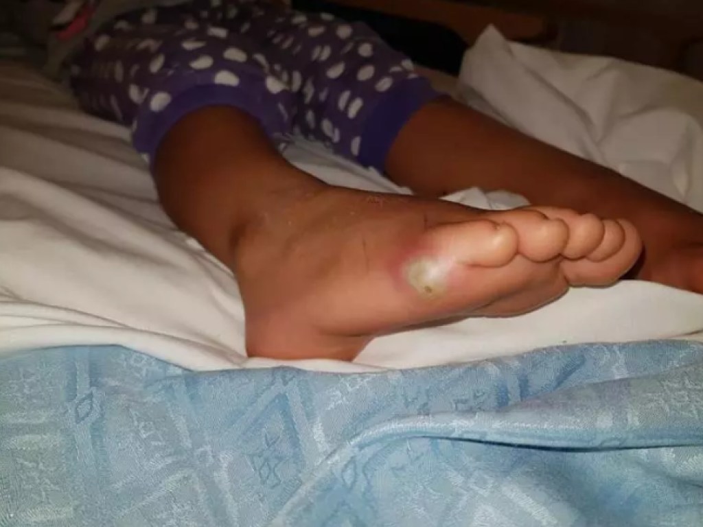 Девочка примерила грязные туфли и подцепила смертельную инфекцию (ФОТО)