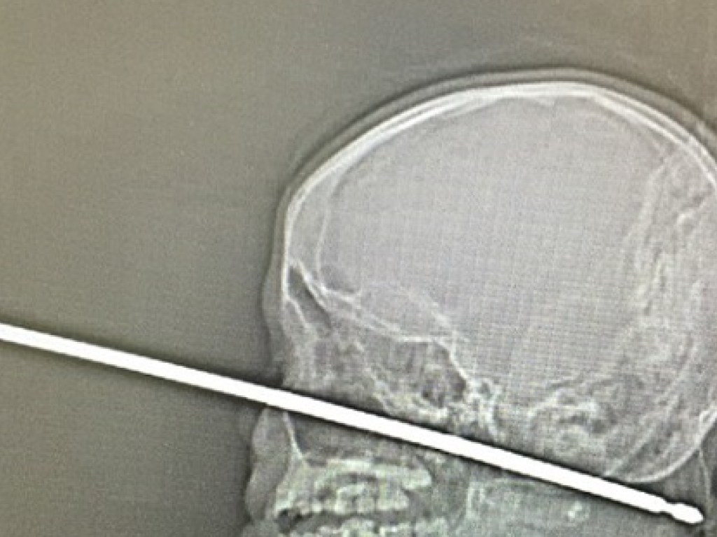 В США ребенок упал лицом на шампур и выжил (ФОТО, ВИДЕО)