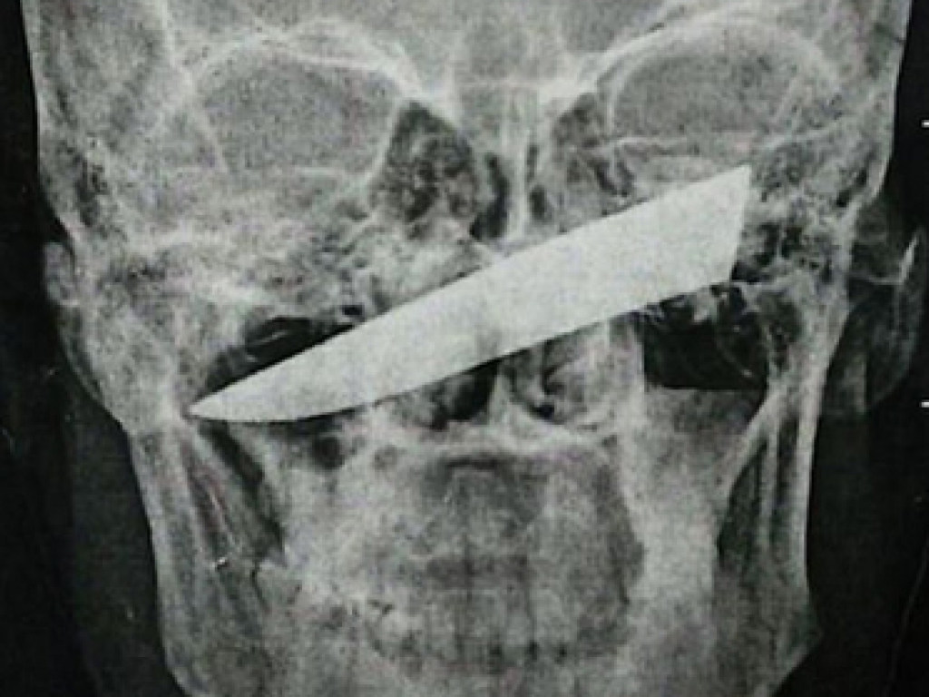 Житель Йоханнесбурга четверо суток провел с ножом в глазнице