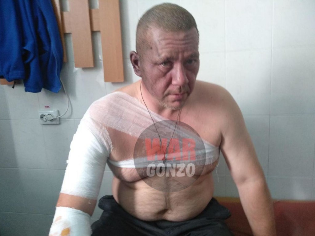 Взрыв в Донецке: обнародовано фото пострадавшего «кандидата» на пост главаря «ДНР»