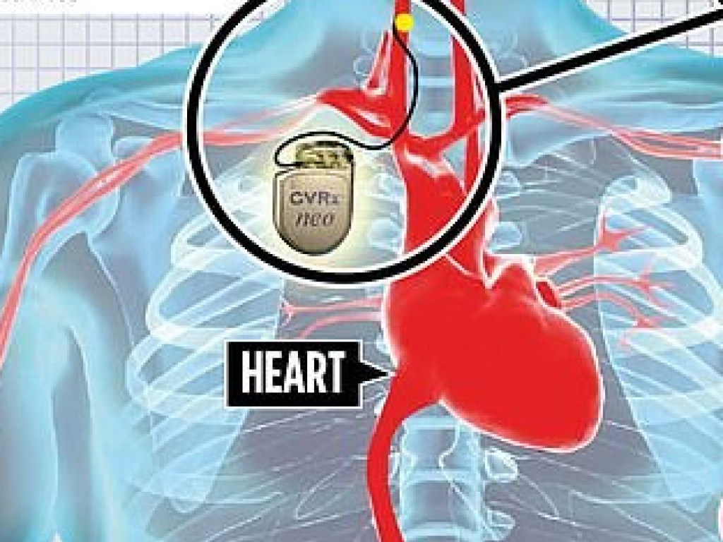 Ученые разработали специальный имплант, который сможет запустить мертвое сердце