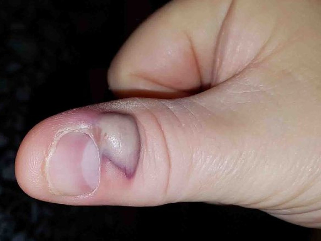 Житель Шотландии получил заражение крови из-за привычки грызть ногти (ФОТО)