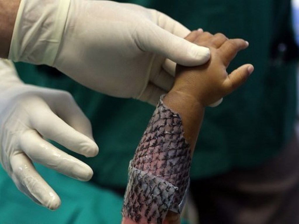 Бразильские ученые научились лечить ожоги рыбьей кожей (ФОТО)