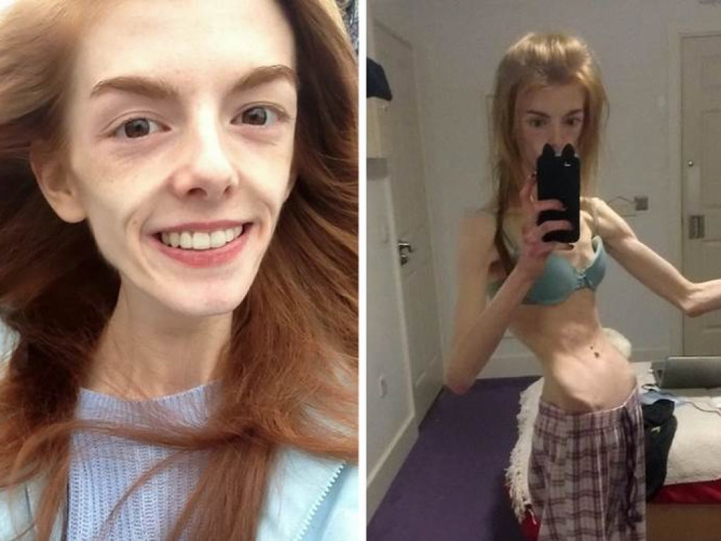 Конфеты спасли от анорексии 21-летнюю британку (ФОТО)