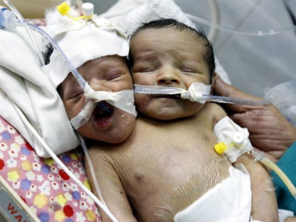 В Йемене родился двухголовый ребенок (ФОТО)