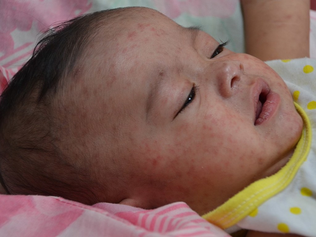 Из-за отказа от вакцинации от кори на Филиппинах умерли более 130 человек 