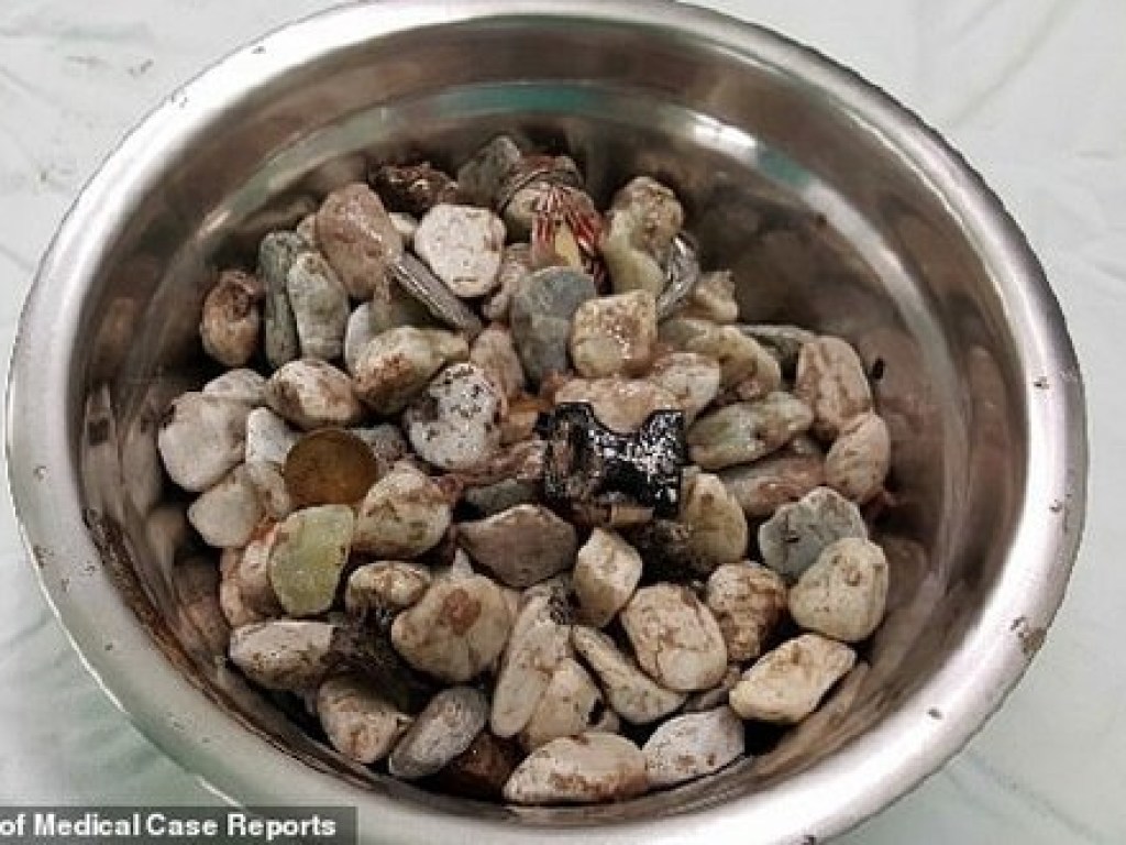 Южной Корее из желудка пациента извлекли около двух килограммов камней, монет и крышечек от бутылок (ФОТО)