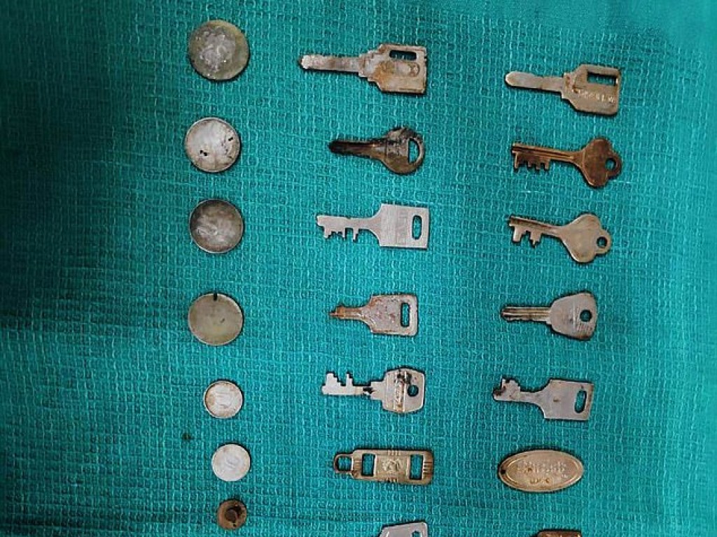 В Индии хирурги извлекли из мужчины 38 металлических предметов (ФОТО)