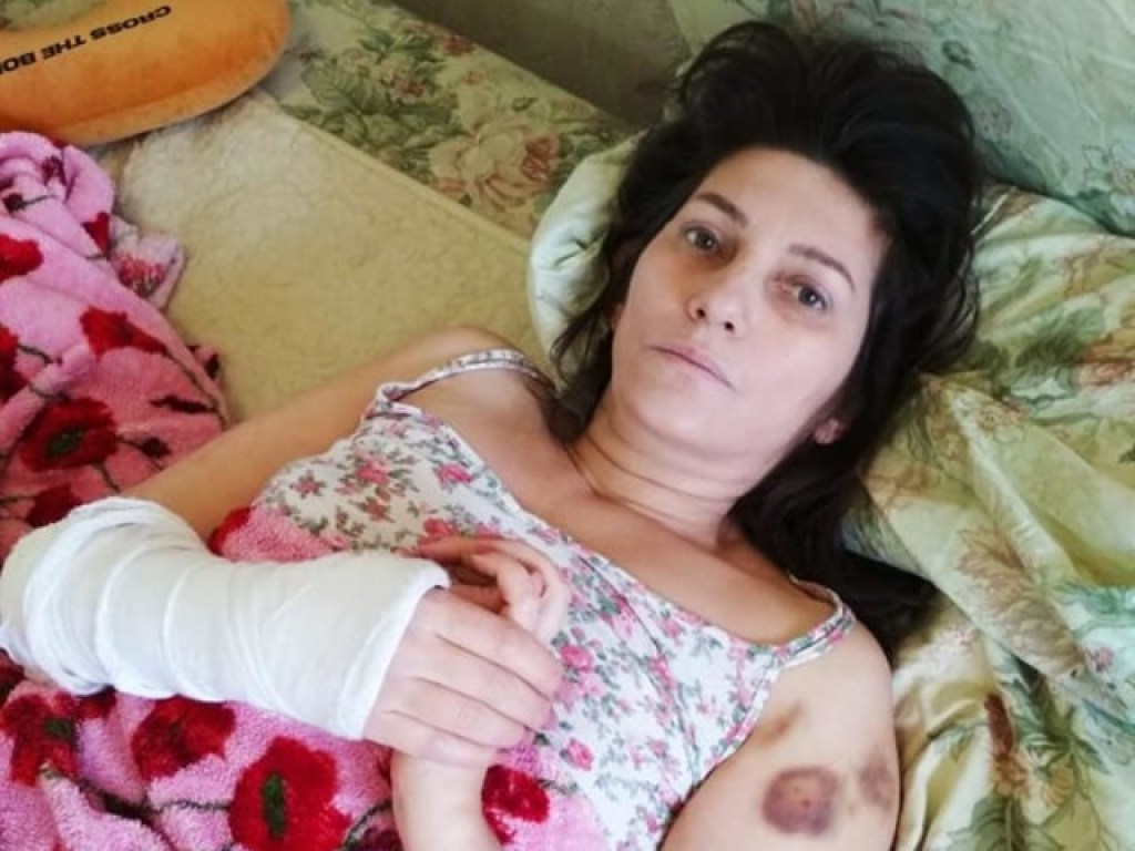 Перелом позвоночника, шрамы, раны: Стая бродячих собак искалечила женщину в Днепре (ФОТО)