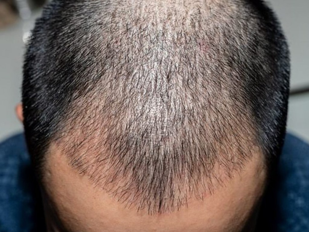 Заплатил 7 тысяч долларов: Мужчина задохнулся после пересадки волос (ФОТО)