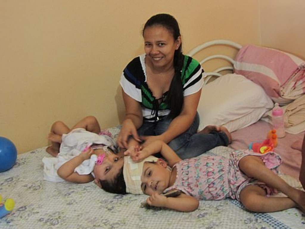 Бразильские хирурги успешно разделили сросшихся сиамских близнецов (ФОТО)