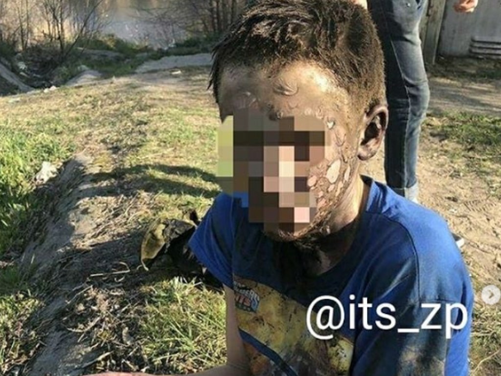 В Запорожье школьник выжил после удара током в 10 тысяч вольт (ФОТО)
