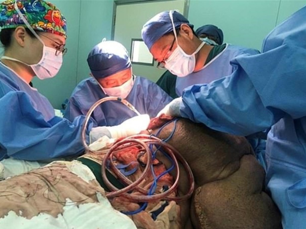 В Китае у мужчины удалили 15-килограмовую опухоль (ФОТО)