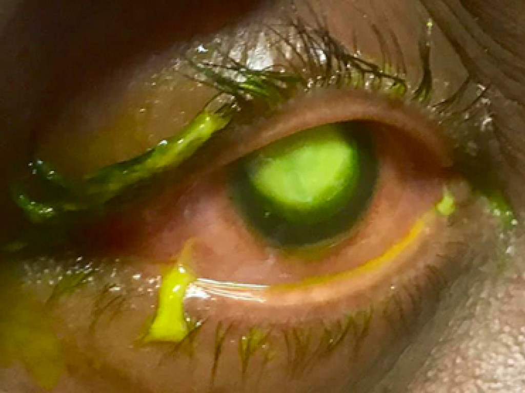 В США женщина забыла снять на ночь линзы и получила жуткую глазную инфекцию (ФОТО, ВИДЕО)