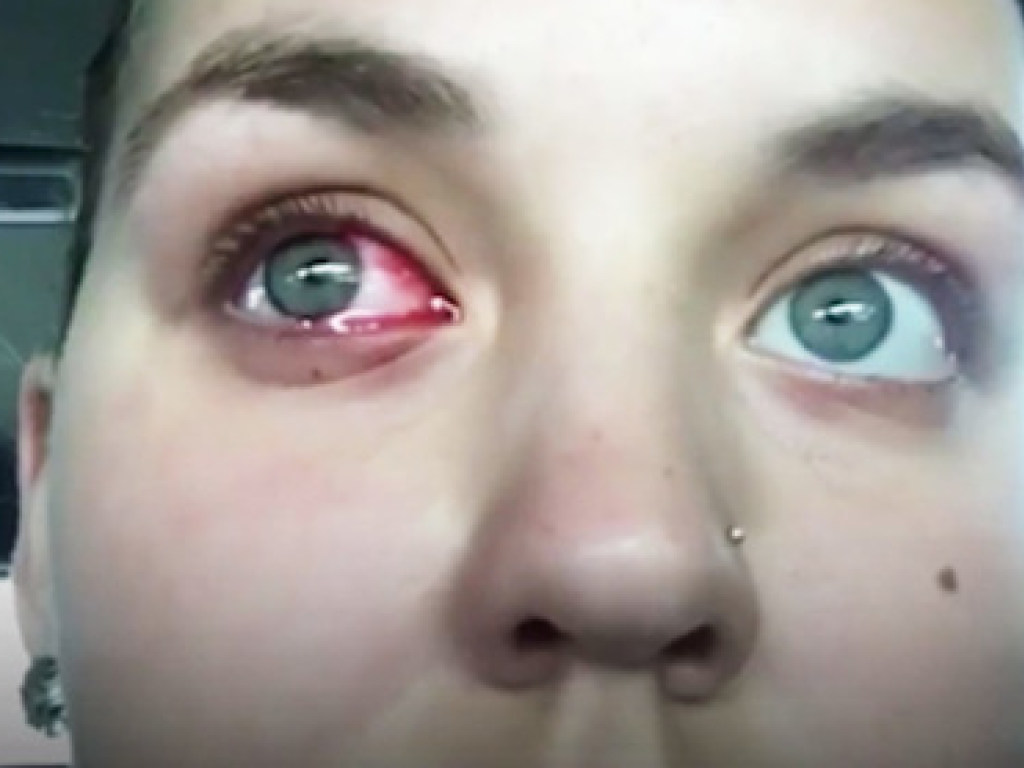 17-летняя австралийка страдает загадочным недугом: идет кровь из глаз и изо рта (ФОТО)