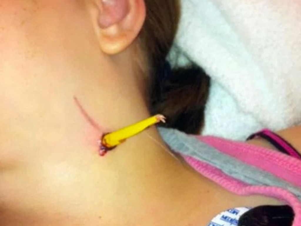 В Канаде карандаш вонзился в шею 11-летней девочки: школьница выжила