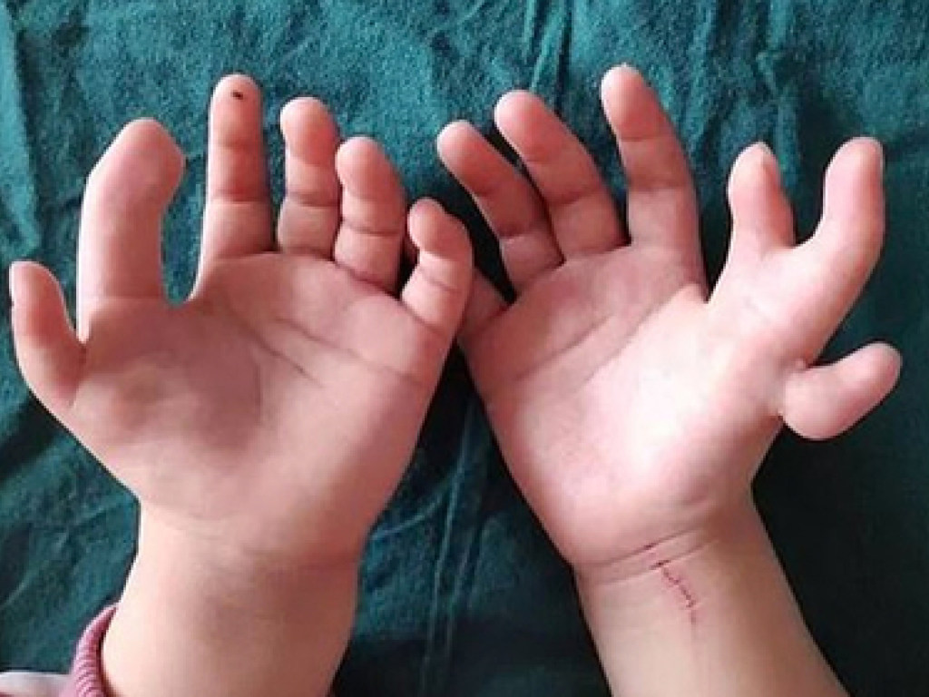  В Китае родилась девочка с 14 пальцами (ФОТО)