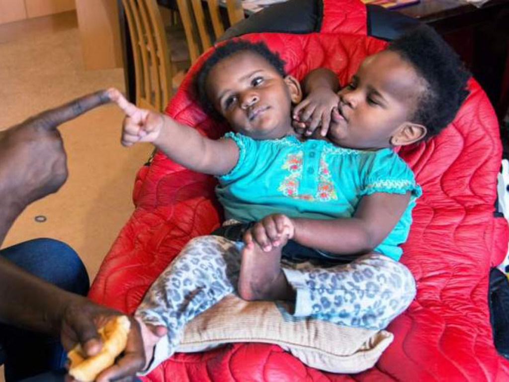 На одном теле две головы: сиамские близнецы из Сенегала дожили до трехлетия (ФОТО)