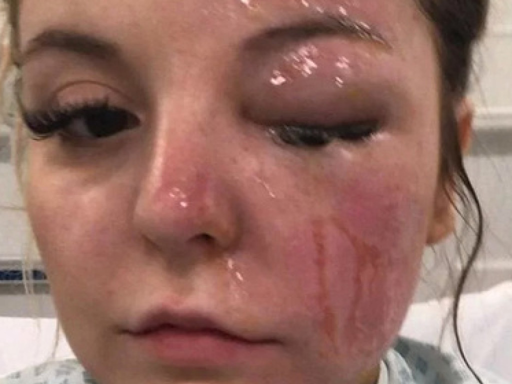 Девушка серьезно травмировала глаз из-за взрыва куриного яйца (ФОТО)