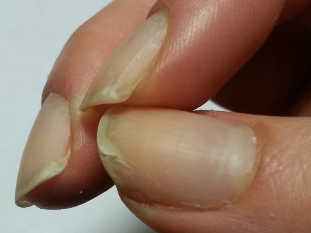 Первые признаки рака: врачи рассказали, что важно следить за своими ногтями