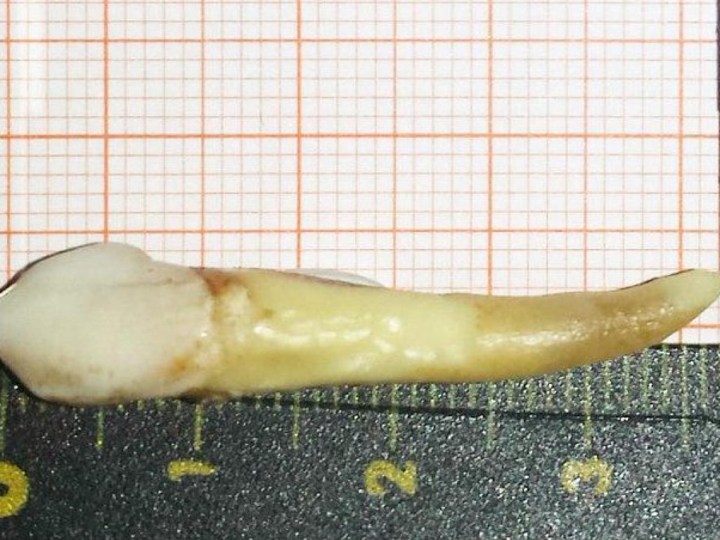 Немецкий стоматолог удалил у пациента зуб невероятных размеров (ФОТО)