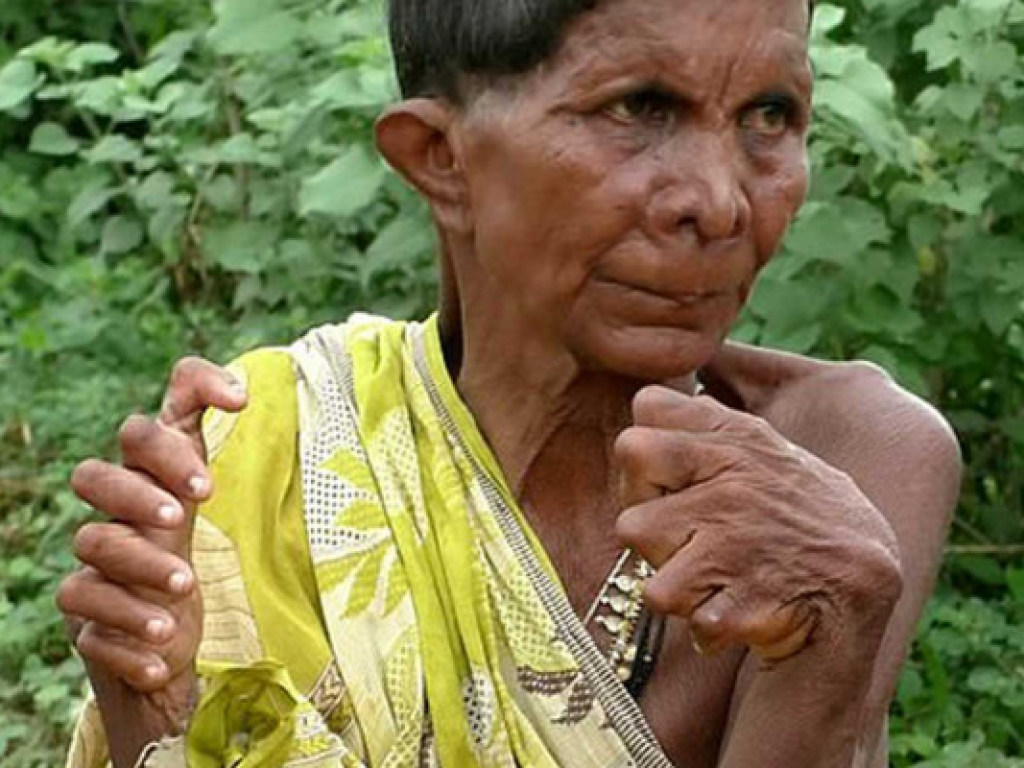 В Индии у пожилой женщины редкое заболевание: 11 лишних пальцев (ФОТО)