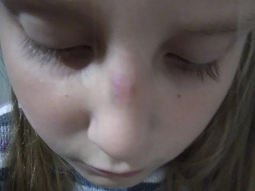 Школьники в Керчи избили новенькую: девочке сломали нос (ФОТО)
