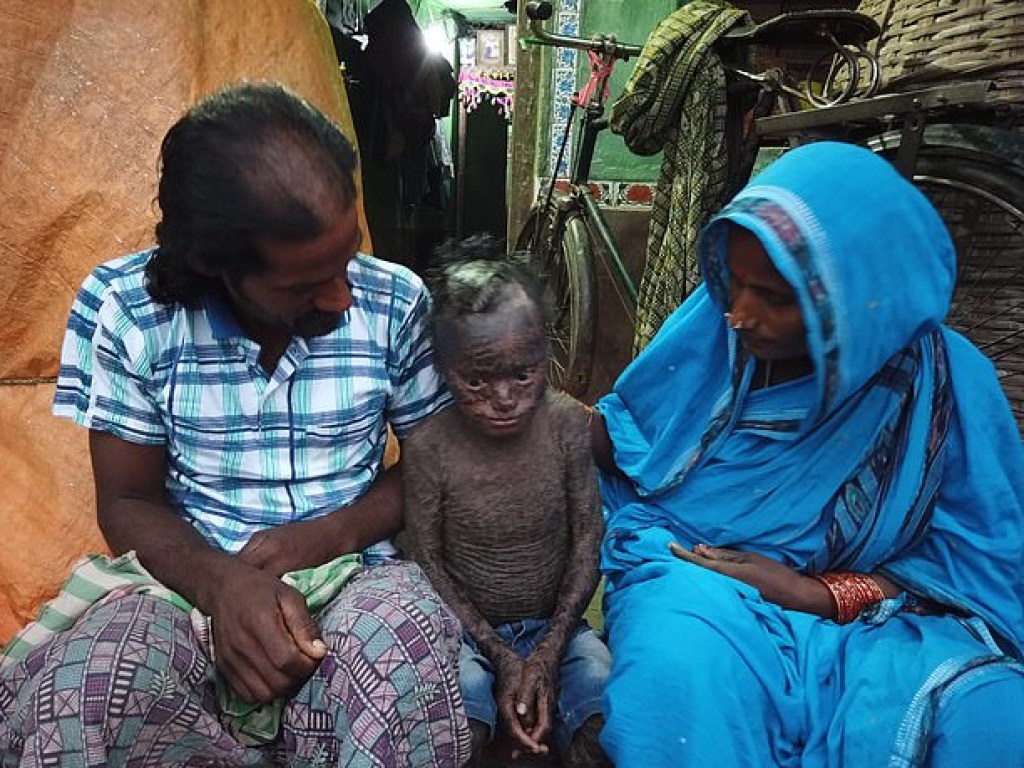 «Принимает ванну каждый час»: В Индии обнаружили мальчика-змею с редким заболеванием (ФОТО)
