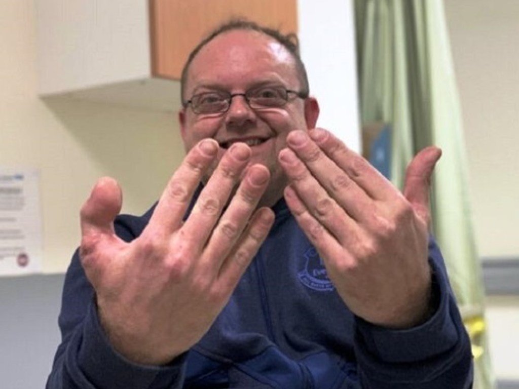 Британскому сапожнику на место потерянного пальца на руки пришили палец с ноги (ФОТО)