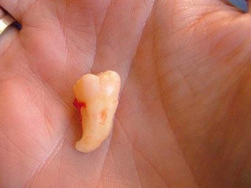 Количество выпавших зубов может определить количество оставшихся лет жизни