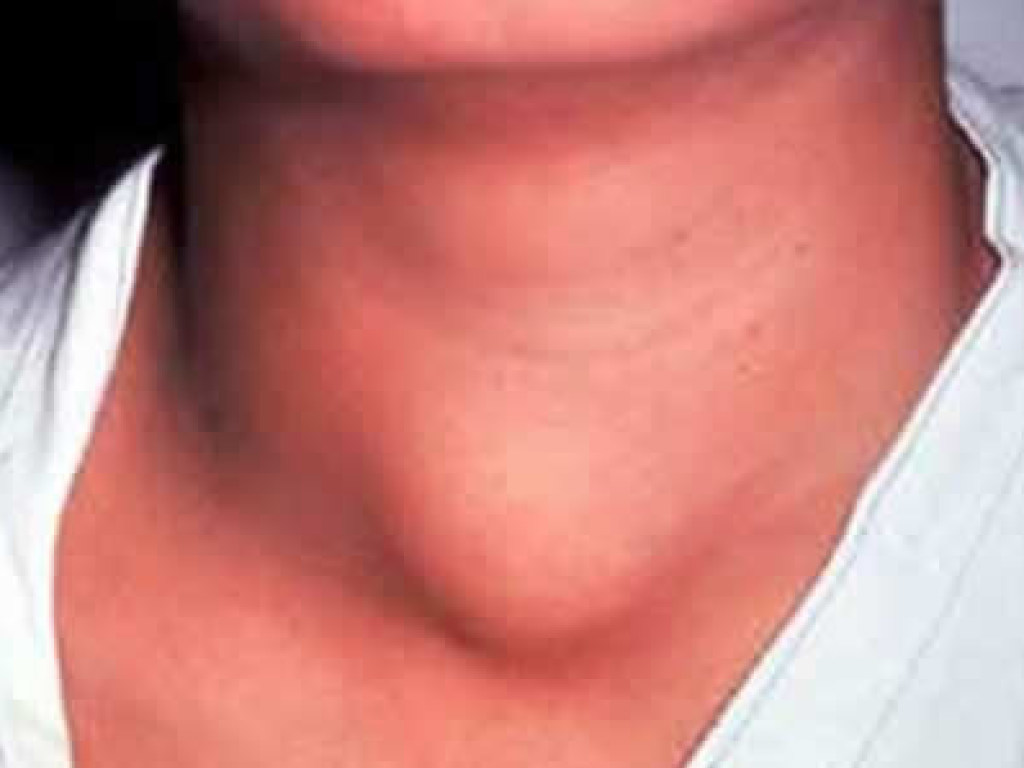 Заболевания щитовидной железы это следствие ОРВИ &#8212; врачи